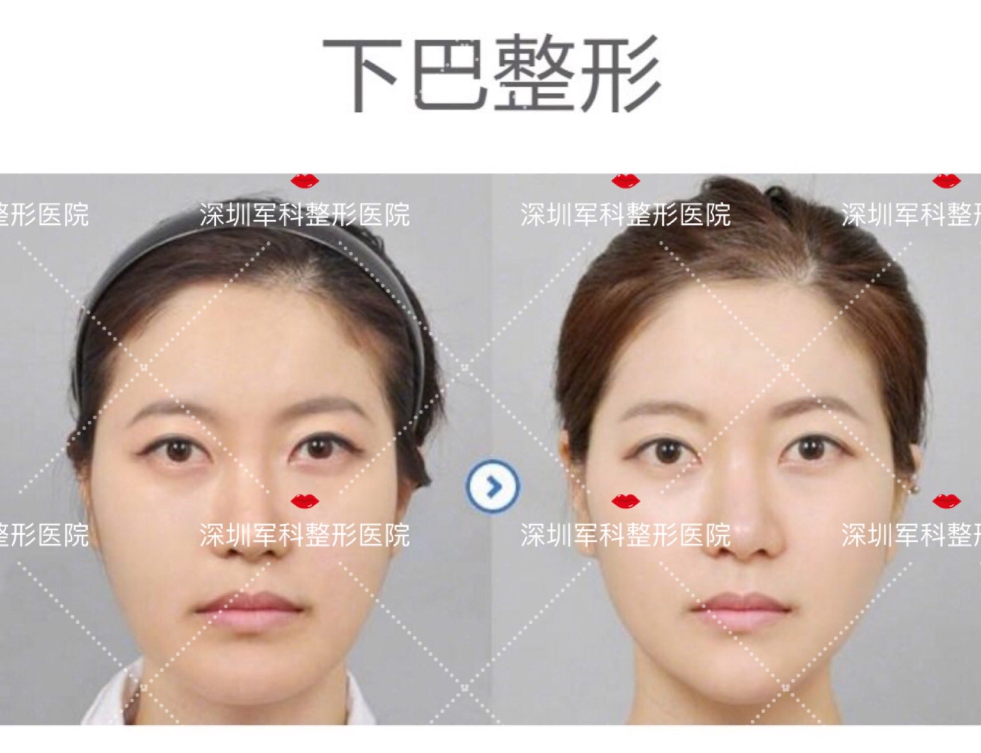 膨体下巴可以做射频紧肤吗_新氧-专业医美服务平台