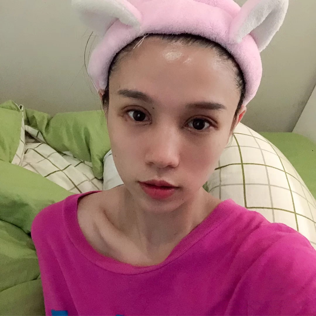 全切双眼皮,开内眼角第5天更新平行6mm双眼皮,昨_圈子-新氧美容整形