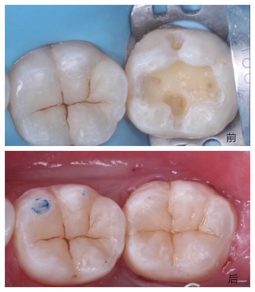 一般浅龋和中龋一次补牙就可以补好,如果达到了深龋,看他离牙神经的