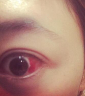 内切眼袋12天后出血图片,愤怒暴击你内切祛眼袋后遗症有多可怕