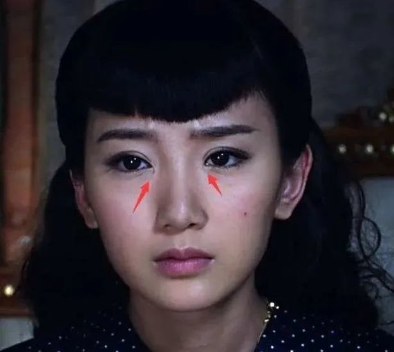 有一些博主说毛晓彤的眼睛也do过,因为眼角有疤痕,双眼皮变宽,整个