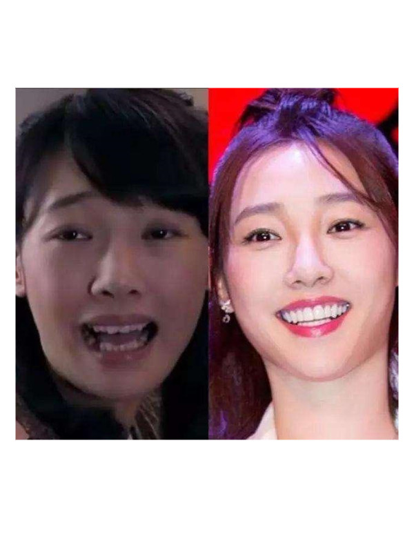 盘点烤瓷牙的危害