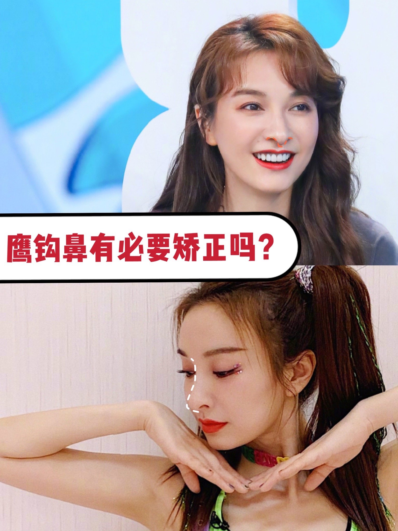 鹰钩鼻有必要矫正吗71