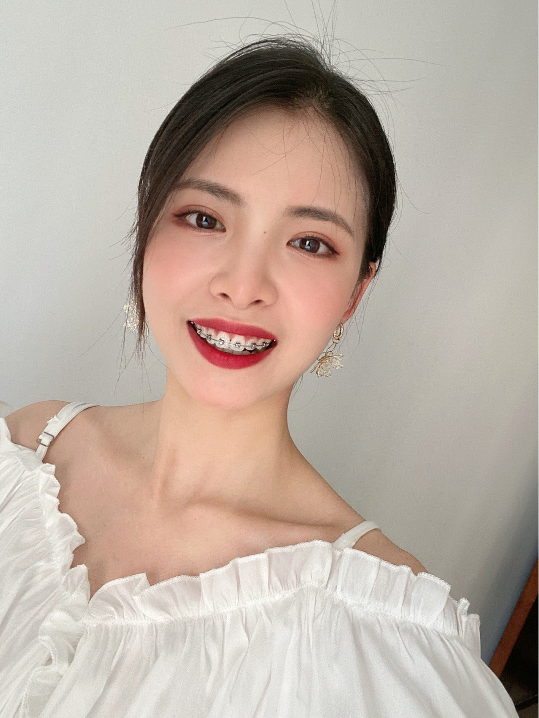 大龄牙套女|牙套日记打卡200天