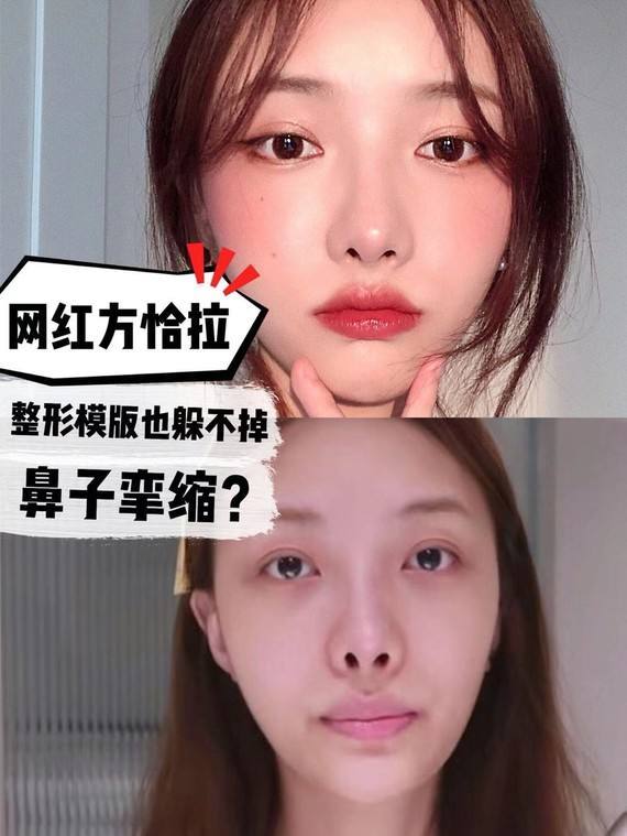 鼻整形后出现鼻尖下旋?