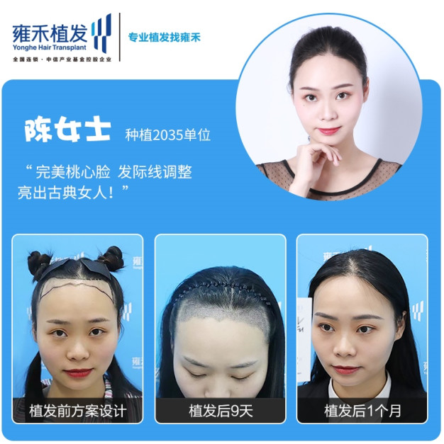 种植发际线现在还需要开刀吗 我朋友后 新氧美容整形