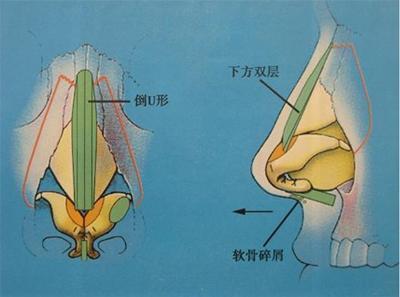 鼻尖下旋图片