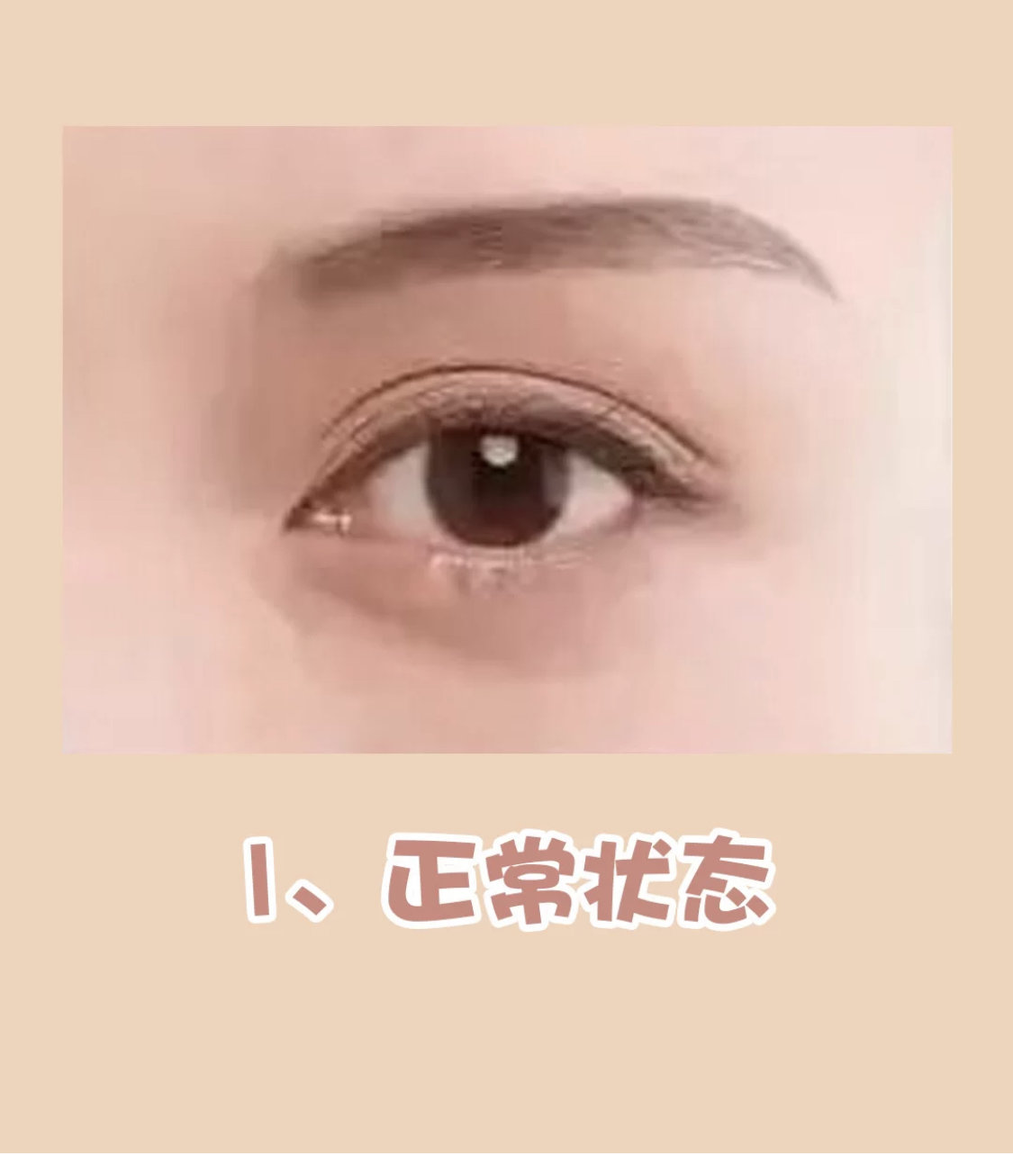 [:56]【武汉美基元】内眦赘皮是什么71内眼角必须_圈子-新氧美容