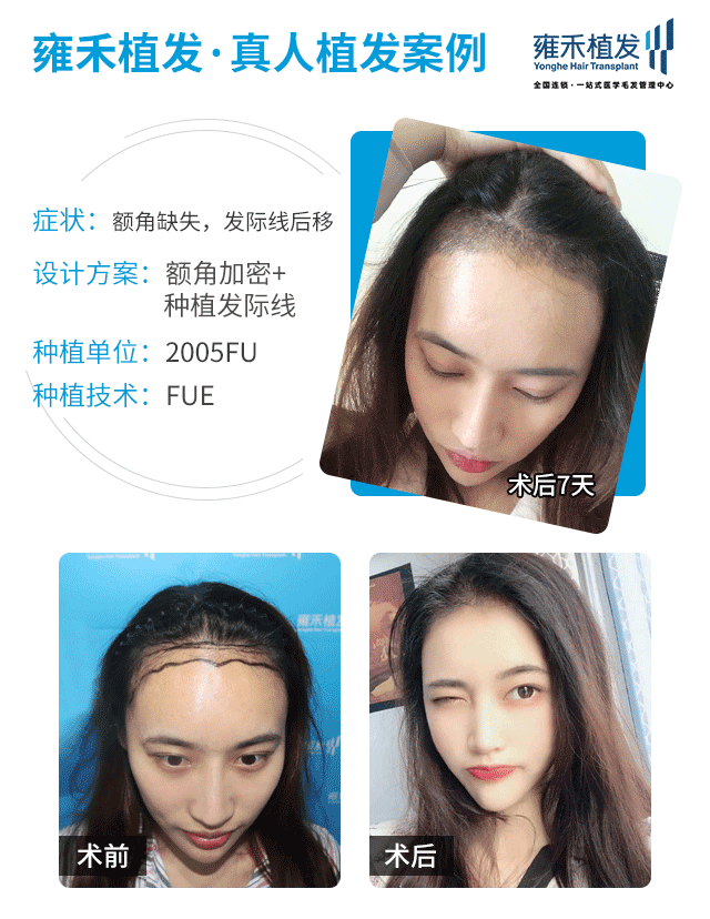 如果本来头发比较软比较少 发际线感觉 新氧美容整形