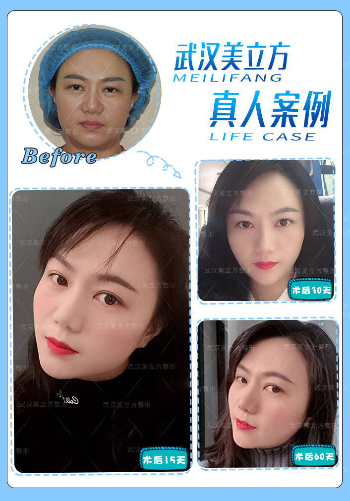 线雕爆炸线填充法令纹,是立即效果,还是慢慢会更撑