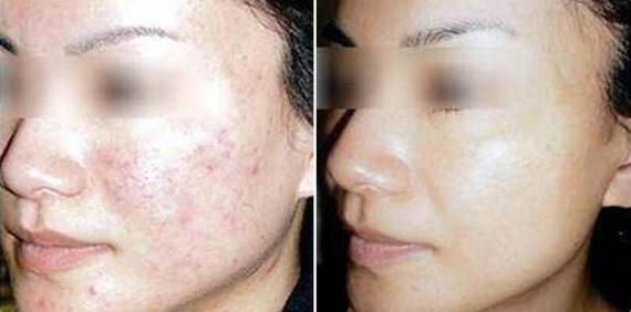 做完微针后脸痒而且皮肤很粗糙天鲁啊做微针后多久恢复正常