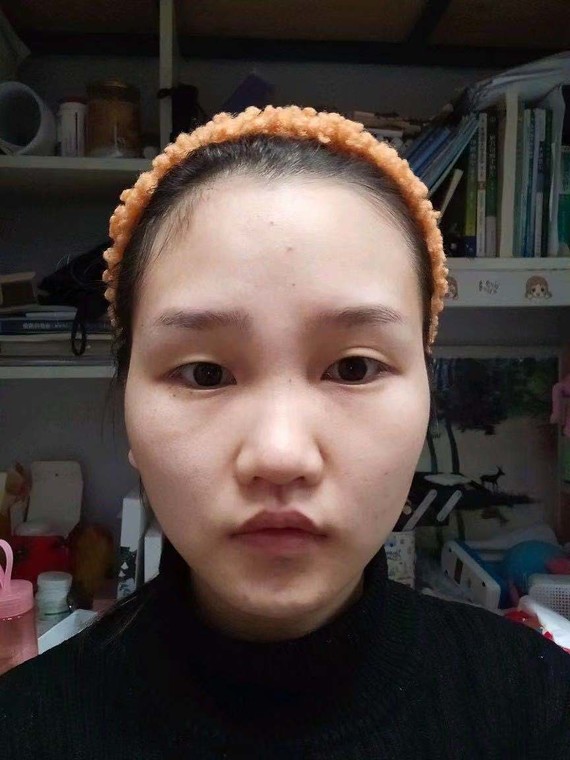 90针对颧骨低平和颧骨高耸问题#求看脸打卡可以考虑适当垫高,也就是