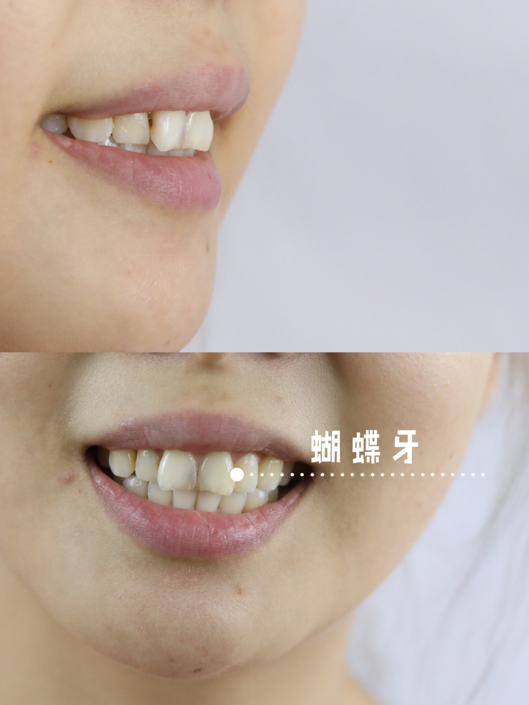 门牙外翻蝴蝶牙蝴蝶牙:门牙_圈子-新氧美容整形