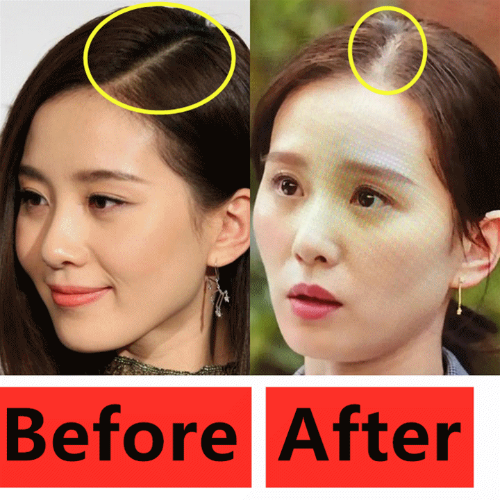 发缝大发际线上移要怎么改善哦?