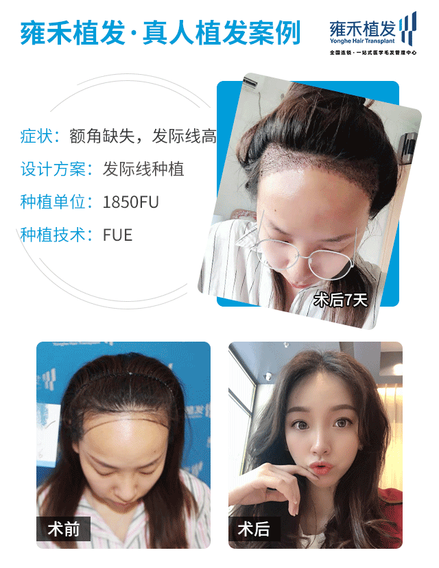 如何预防脱发和白发 新氧 专业医美服务平台