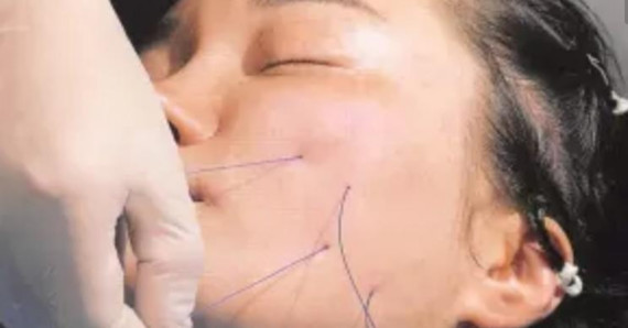 但是并不自然,随着线雕后的恢复,埋入的蛋白线会被水解,在水解的过程