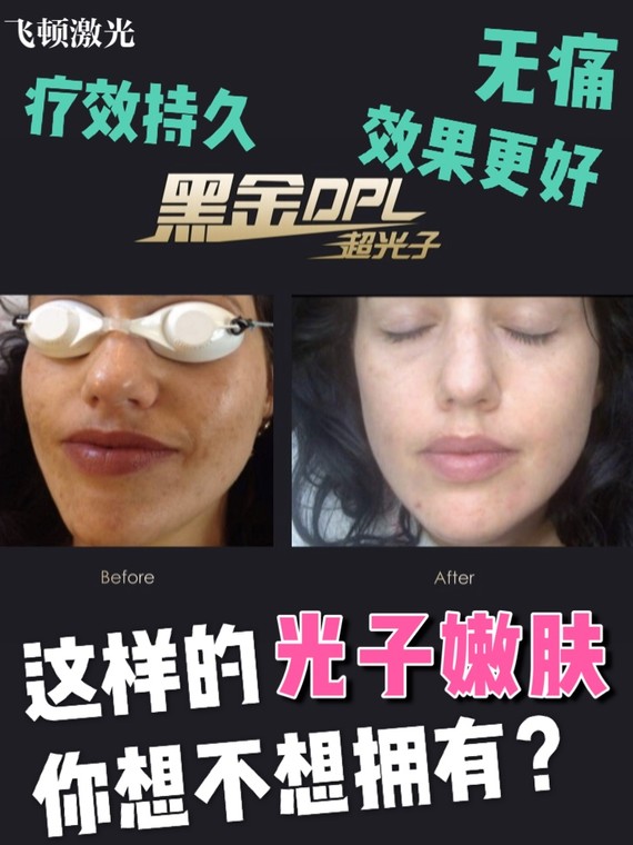 重新定義光子嫩膚,開啟無痛美膚新時代