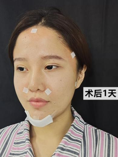 脂肪填充一个月眼睛深邃还小怎么回事
