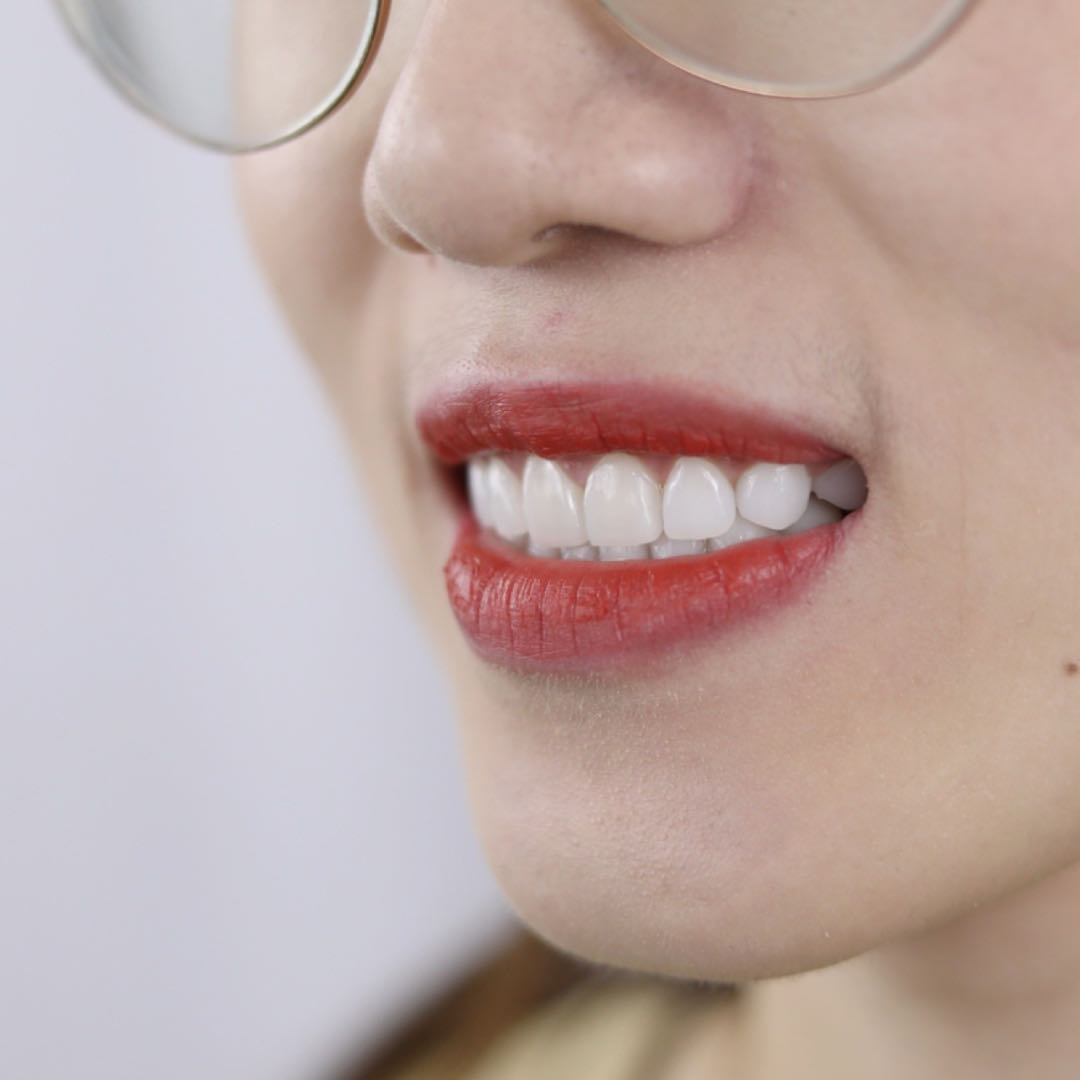 牙缝女孩的自述|牙齿全瓷贴面