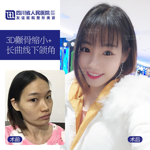 轮廓不好看 颧骨宽 额头窄 怎么办 新氧美容整形