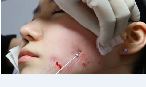 阿娇谈:线雕针眼怎么处理;线雕感染的初期症状;涨知识!