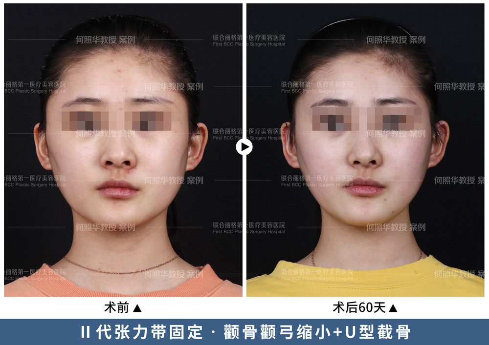 做完颧骨手术最快多久可以整牙.