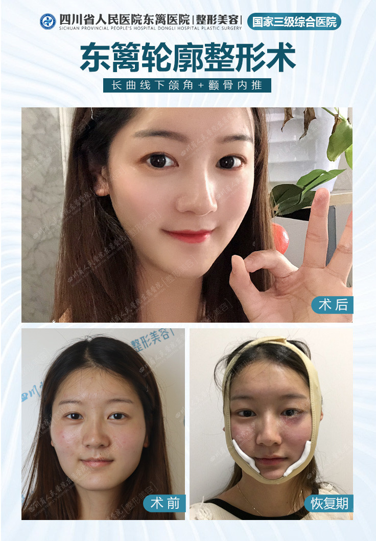 脸型不对称 做下颌角手术能改善么 新氧美容整形 脸型不对称 做下颌角手术能改善么 新氧美容整形