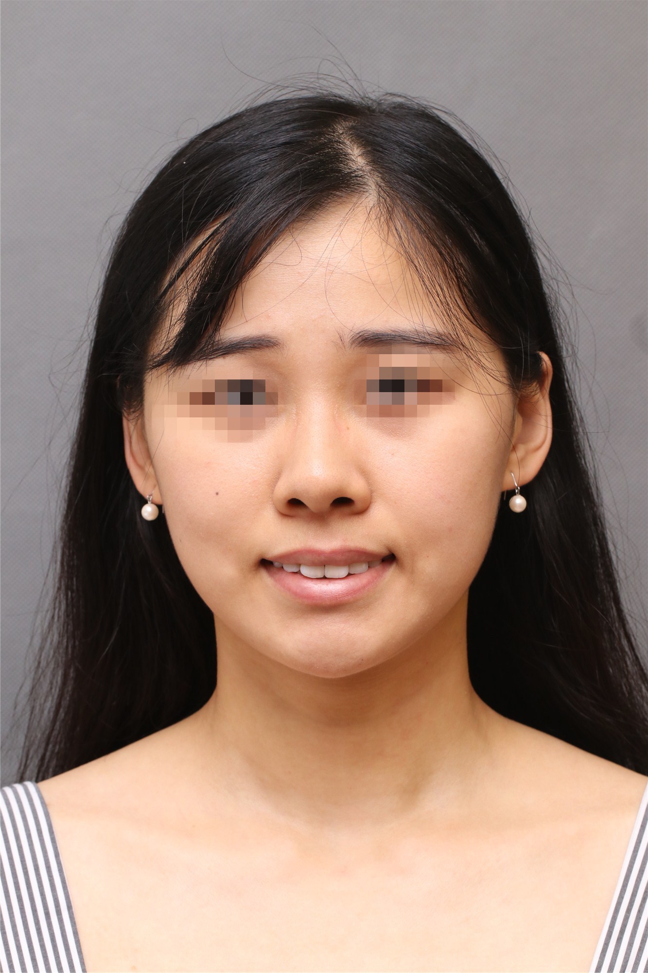 我的情况:(深覆合咬合深,上牙有点骨性的前突而且上_圈子-新氧美容