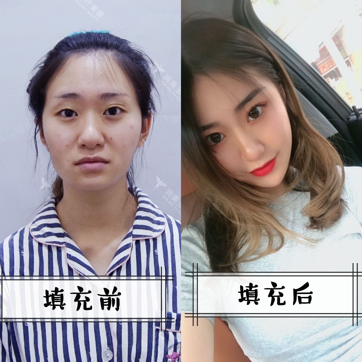 单侧脸颊凹陷怎么办?_新氧-专业医美服务平台