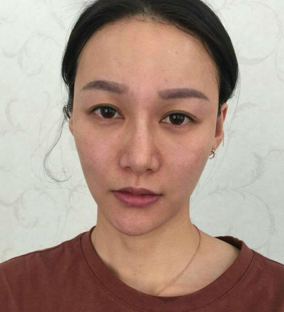 肤色不均,暗黄无光泽,也可以通过aopt来进行治疗_圈子-新氧美容整形