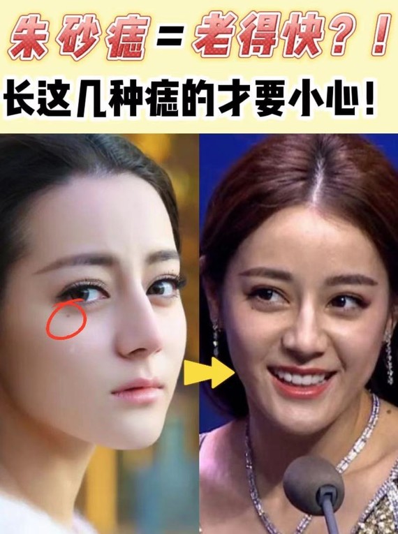 朱砂痣老得快长这几种痣的才要小心060606