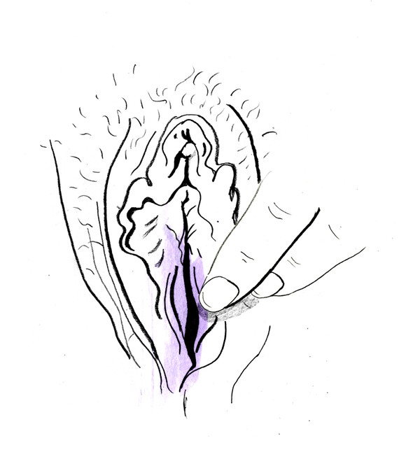 如果青春期小阴唇发育异常肥大,16岁后需要在家长的