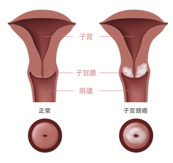 正常宫颈口图片对比图片