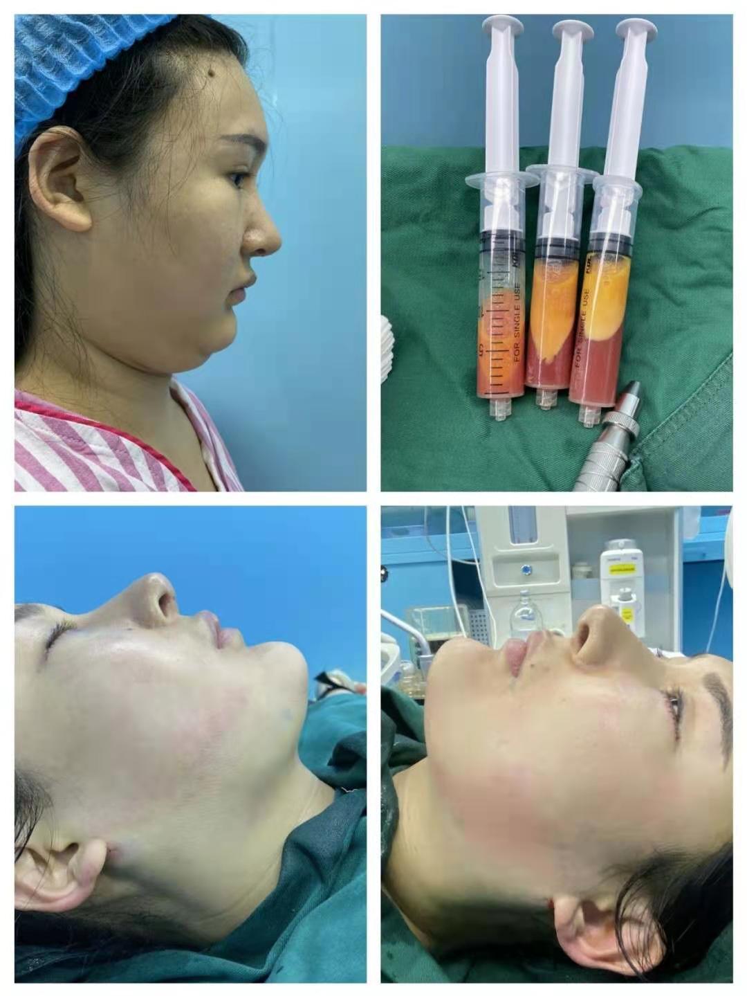 吸脂可以去双下巴吗 新氧 专业医美服务平台