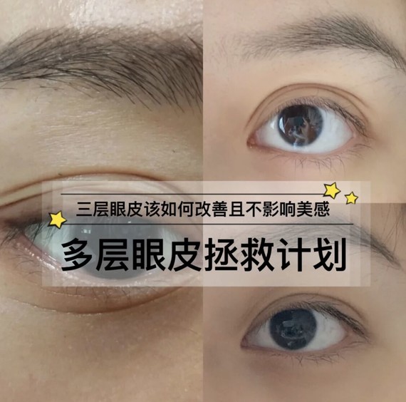 【武汉美基元】三层眼皮该如何改善
