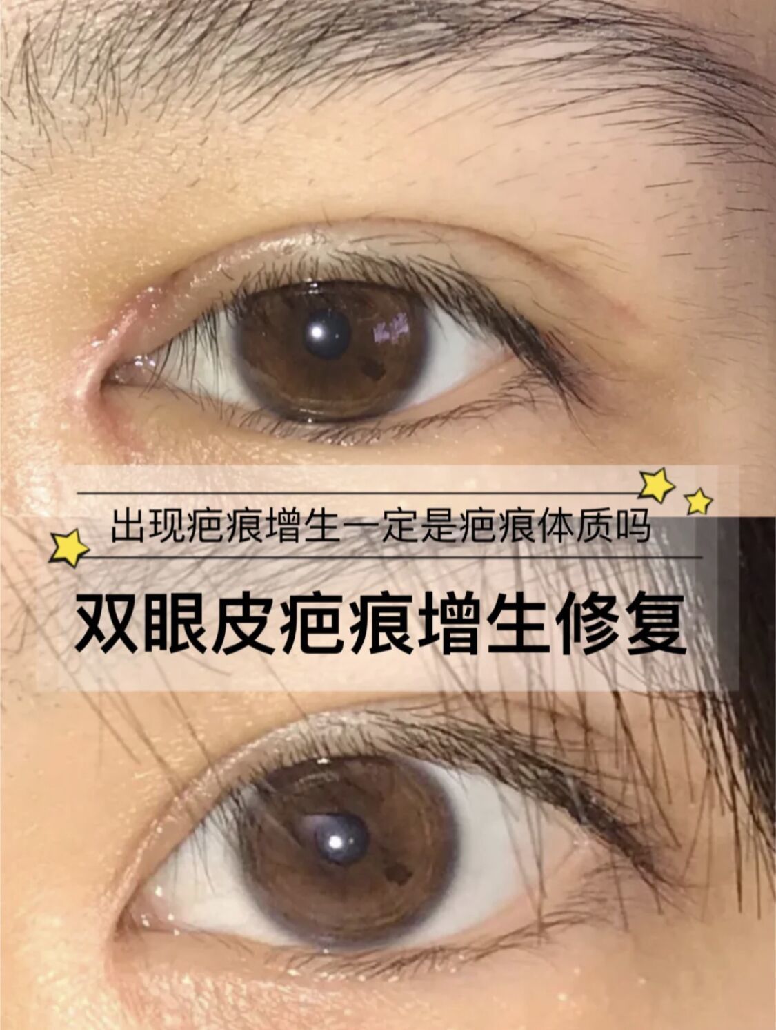 武汉美基元双眼皮术后疤痕增生可以修复吗