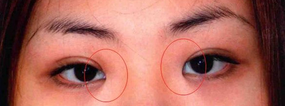 1,内眦赘皮严重:一般单眼皮或者内双都会存在内眦赘皮比较严重的