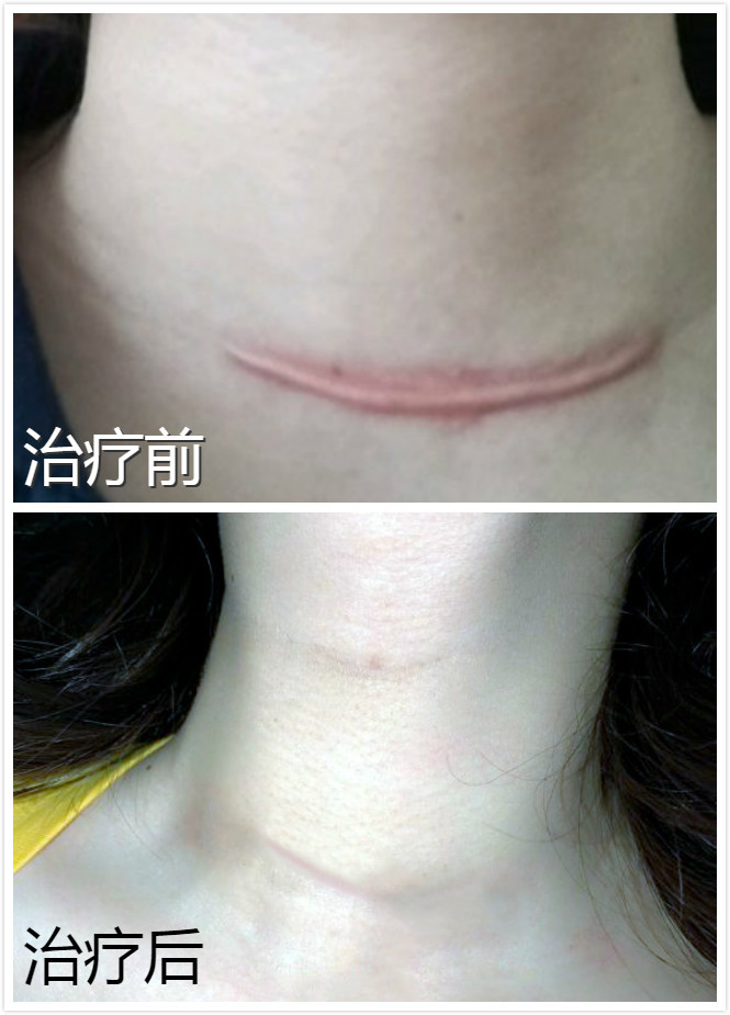 脖子部位有之前做甲状腺手术的疤痕,可以去掉么?