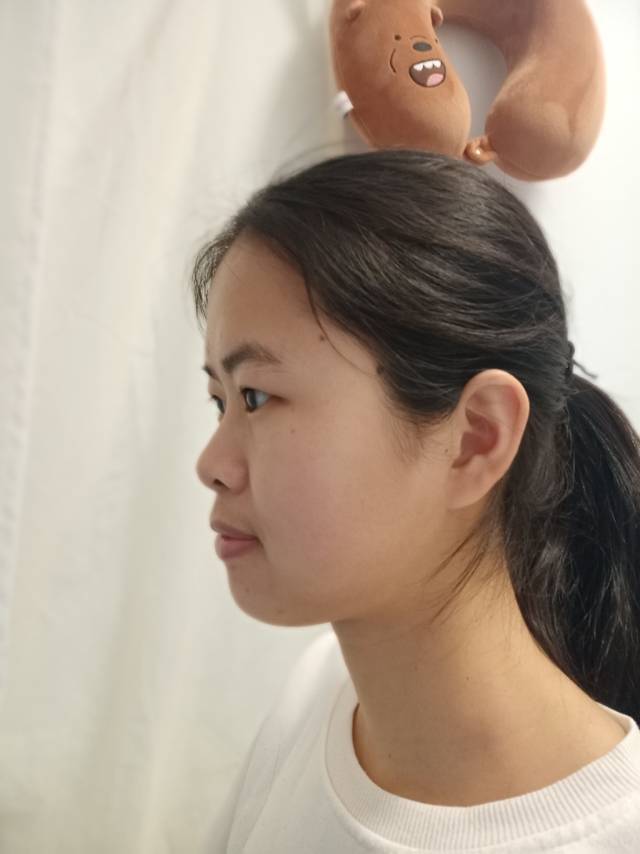 您好请问我的凸嘴可以通过戴牙套减轻吗法令纹和泪痕沟如何改善呢谢谢