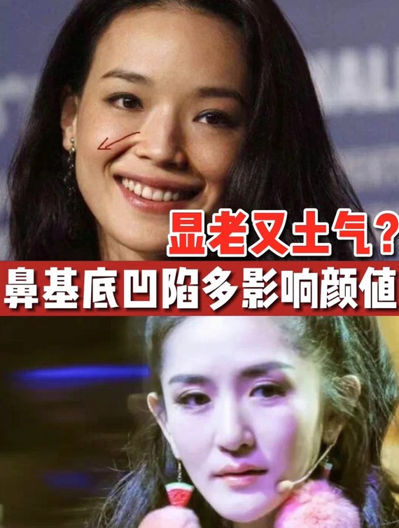 显老又土气鼻基底凹陷会带来哪些颜值bug