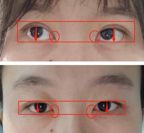 但是整体出现黑眼球暴露度不高,以及眼裂长度没有改