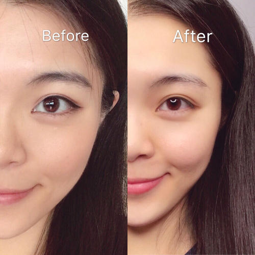 苹果肌下垂做线雕提升效果好吗