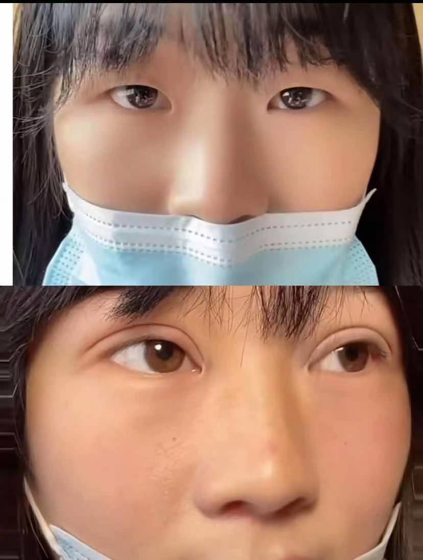 8mm双眼皮术后2个月这开扇双眼皮绝了