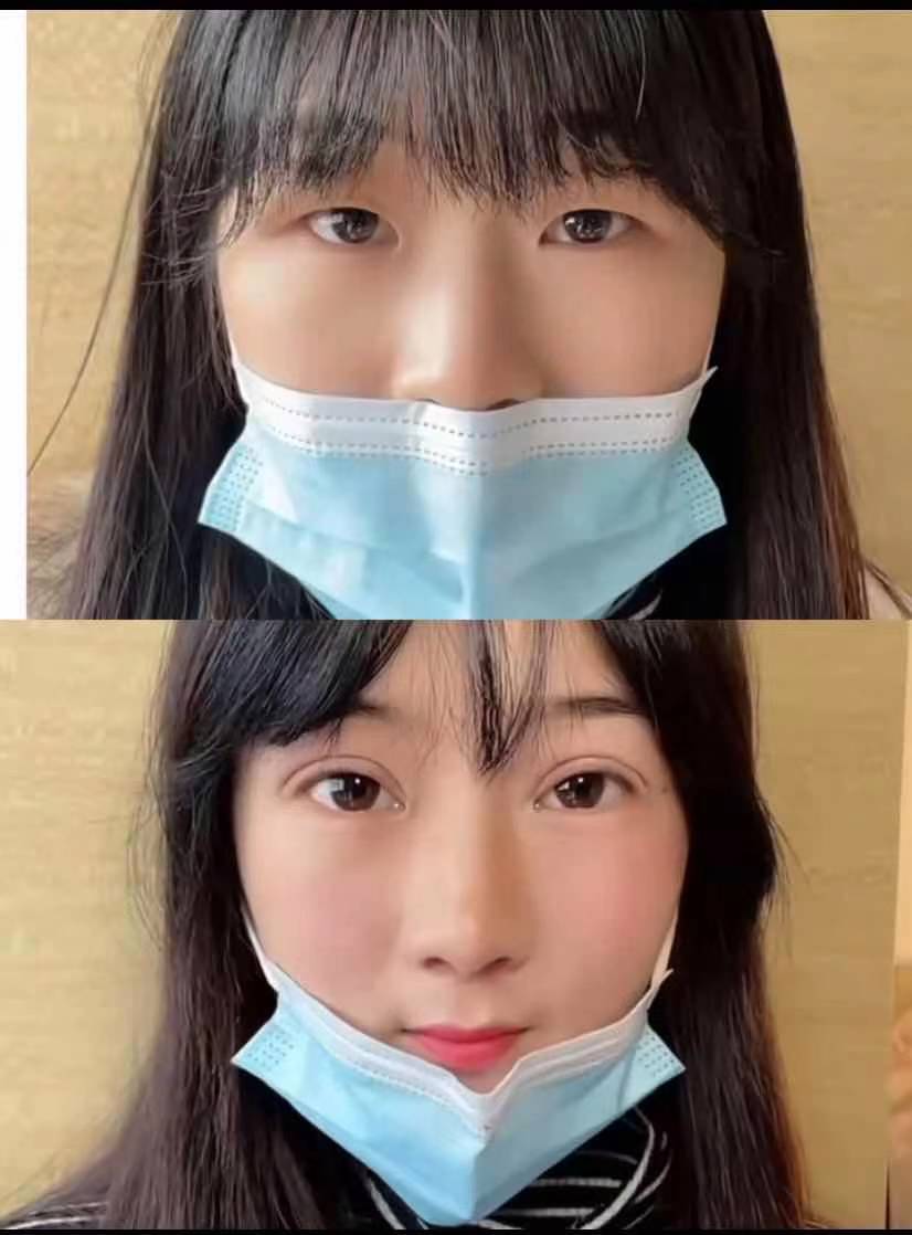 8mm双眼皮术后2个月这开扇双眼皮绝了