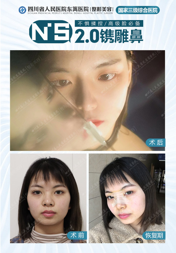 隆鼻后甲板几天能拿掉 新氧 专业医美服务平台 隆鼻后甲板几天能拿掉 新氧 专业医美服务平台