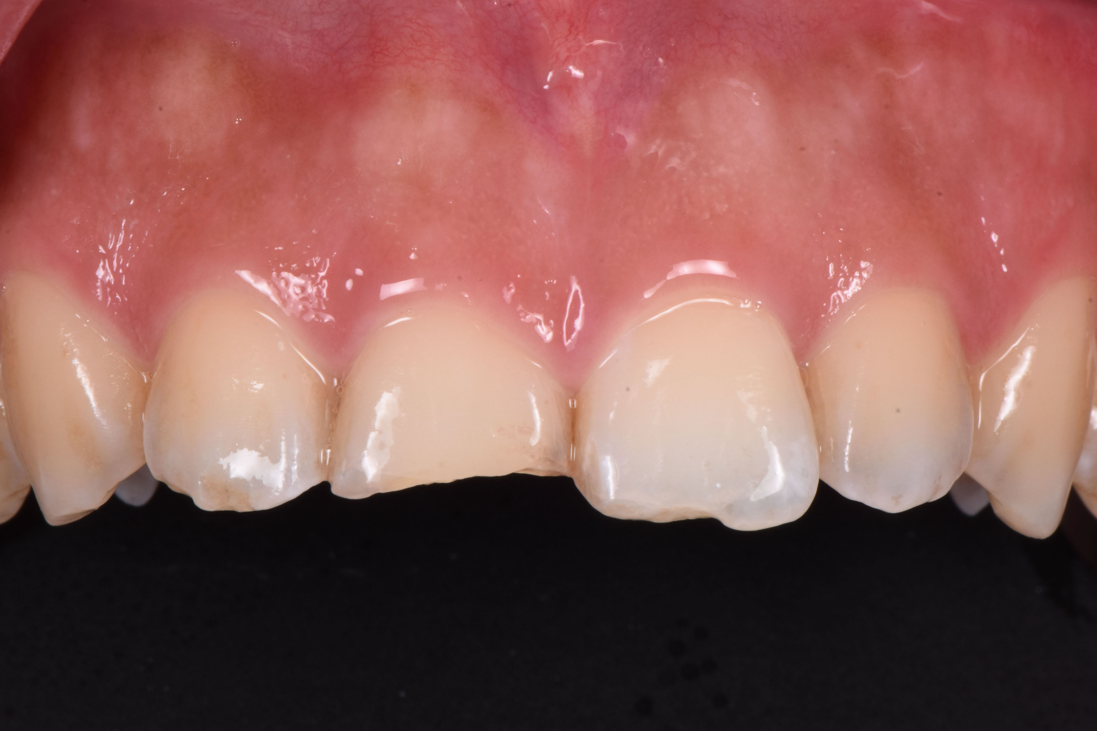 做牙齿贴片的全瓷贴片哪个品牌的好