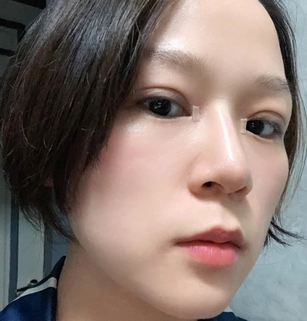 双眼皮术后一个月打卡我是如何防止疤痕增生的