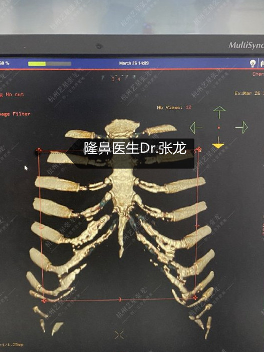 给大家看一个钙化严重的肋骨片做鼻整形肋骨是一个比较_圈子-新氧美容