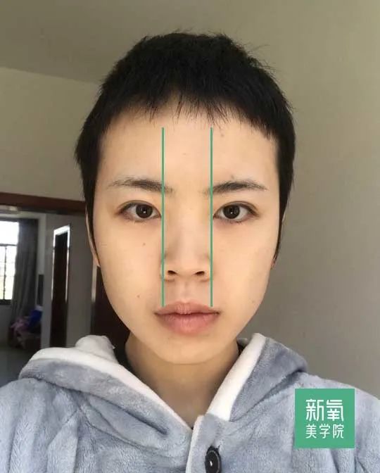 妹子主要的bug集中在鼻唇处.鼻子的鼻翼比较大,鼻孔有些外露.