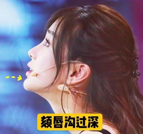 植入的假体过大,过翘,就容易出现颏唇沟过深的情况.